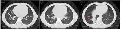 Case report: A case of SLC26A4 mutations causing pendred syndrome and non-cystic fibrosis bronchiectasis